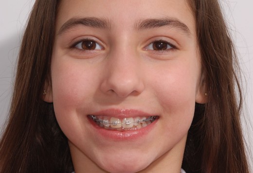 Self Ligating Braces