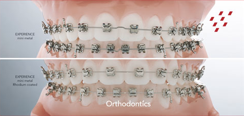 Rhodium coated braces