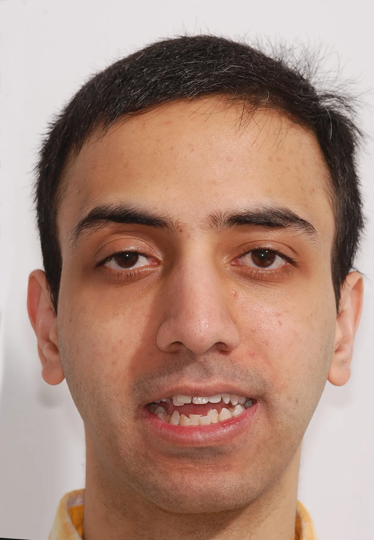 Before and after dentistry