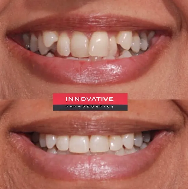 Before and after dentures